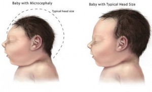 microcephaly-comparison2